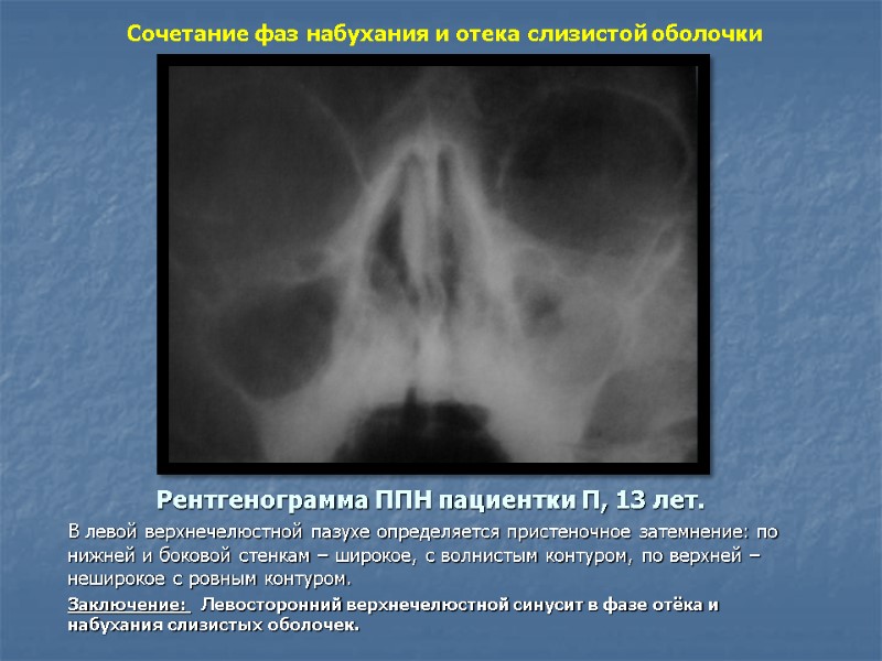 Рентгенограмма ППН пациентки П, 13 лет. В левой верхнечелюстной пазухе определяется пристеночное затемнение: по